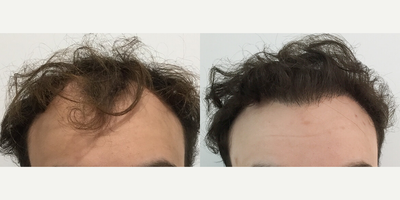 Case 8577 - Man treated with Hair Transplant