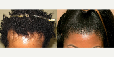 Case 8578 - Woman treated with Hair Transplant
