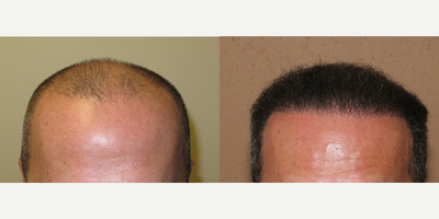 Case 8579 - Man treated with Hair Transplant