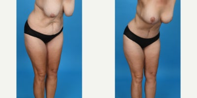Case 858 - 35-44 year old woman treated with Tummy Tuck, Drainless Tummy Tuck, Liposuction, Mommy Makeover
