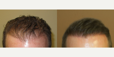 Case 8580 - Man treated with Hair Transplant