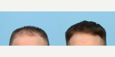 Case 8583 - 35-44 year old man treated with FUE Hair Transplant, Hair Transplant, Hair Loss Treatment, PRP for Hair Loss