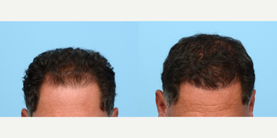 Case 8584 - 35-44 year old man treated with FUE Hair Transplant, Hair Transplant, Hair Loss Treatment, PRP for Hair Loss