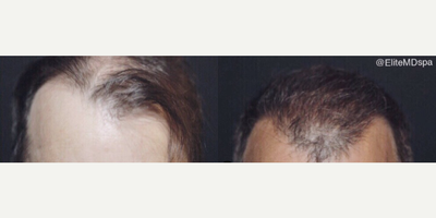 Case 8585 - Man treated with Hair Transplant