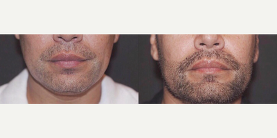 Case 8586 - Man treated with Hair Transplant