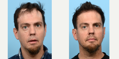 Case 8587 - 35-44 year old man treated with FUE Hair Transplant, Hair Transplant, Hair Loss Treatment, PRP for Hair Loss