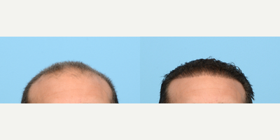 Case 8588 - 45-54 year old man treated with FUE Hair Transplant, Hair Transplant, Hair Loss Treatment, PRP for Hair Loss
