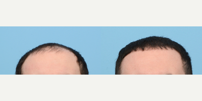 Case 8589 - 18-24 year old man treated with FUE Hair Transplant, Hair Transplant, Hair Loss Treatment, PRP for Hair Loss