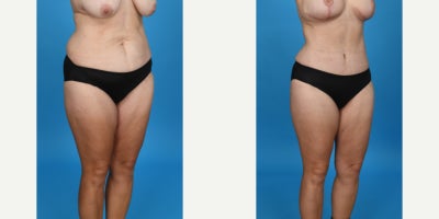 Case 859 - 35-44 year old woman treated with Tummy Tuck, Drainless Tummy Tuck, Liposuction, Mommy Makeover