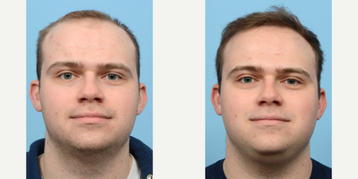 Case 8590 - 18-24 year old man treated with FUE Hair Transplant, Hair Transplant, Hair Loss Treatment, PRP for Hair Loss