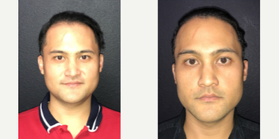 Case 8591 - Man treated with Hair Transplant