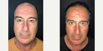 Case 8592 - Man treated with Hair Transplant