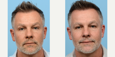 Case 8593 - 45-54 year old man treated with Hair Transplant