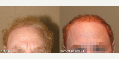 Case 8594 - Man treated with NeoGraft, Hair Transplant