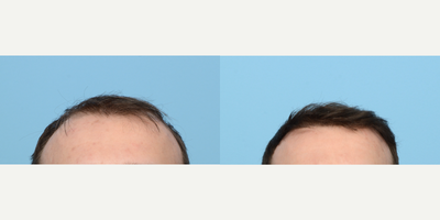 Case 8595 - 25-34 year old man treated with FUE Hair Transplant, Hair Transplant, Hair Loss Treatment, PRP for Hair Loss, NeoGraft, Low-Leve