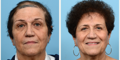 Case 8596 - 65-74 year old woman treated with Hair Transplant