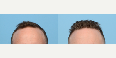 Case 8597 - 35-44 year old man treated with FUE Hair Transplant, Hair Transplant, Hair Loss Treatment, PRP for Hair Loss, NeoGraft
