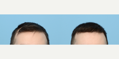 Case 8598 - 25-34 year old man treated with FUE Hair Transplant, Hair Transplant, Hair Loss Treatment, PRP for Hair Loss, NeoGraft