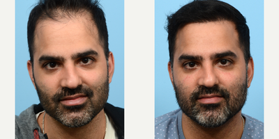 Case 8599 - 35-44 year old man treated with FUE Hair Transplant, Hair Transplant, Hair Loss Treatment, PRP for Hair Loss, NeoGraft