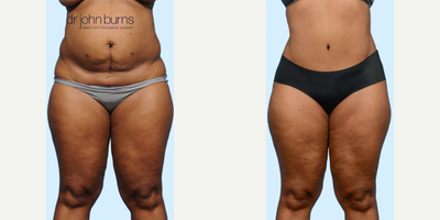 Case 86 - Woman treated with Tummy Tuck