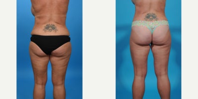 Case 860 - 35-44 year old woman treated with Tummy Tuck Revision, Mini Tummy Tuck, Drainless Tummy Tuck, Vaser Liposuction, Tummy Tuck, Dia