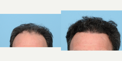 Case 8600 - 55-64 year old man treated with FUE Hair Transplant, Hair Transplant, Hair Loss Treatment, PRP for Hair Loss, NeoGraft