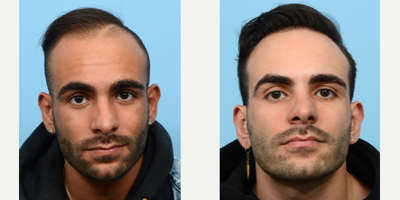 Case 8601 - 25-34 year old man treated with Hair Transplant, Hair Loss Treatment, PRP for Hair Loss, FUE Hair Transplant, NeoGraft