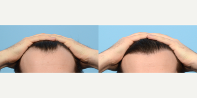 Case 8602 - 18-24 year old woman treated with FUE Hair Transplant, NeoGraft, Hair Transplant, Hair Loss Treatment, PRP for Hair Loss