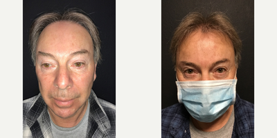 Case 8603 - Man treated with Hair Transplant