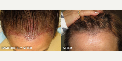 Case 8604 - Woman treated with Hair Transplant