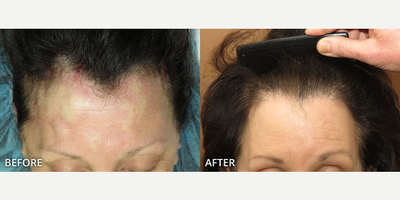Case 8605 - Woman treated with Hair Transplant