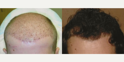 Case 8606 - Man treated with Hair Transplant