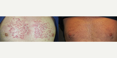 Case 8607 - Man treated with Hair Transplant