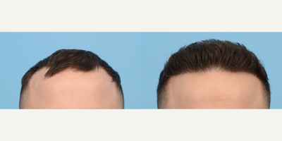 Case 8608 - 25-34 year old man treated with FUE Hair Transplant, Hair Transplant, Hair Loss Treatment, PRP for Hair Loss, NeoGraft