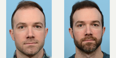 Case 8609 - 25-34 year old man treated with FUE Hair Transplant, Hair Transplant, Hair Loss Treatment, PRP for Hair Loss, NeoGraft