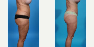 Case 861 - 35-44 year old woman treated with Tummy Tuck Revision, Mini Tummy Tuck, Drainless Tummy Tuck, Vaser Liposuction, Tummy Tuck, Dia