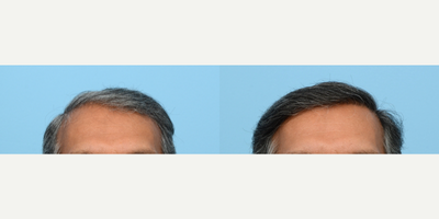 Case 8610 - 55-64 year old man treated with FUE Hair Transplant, Hair Transplant, Hair Loss Treatment, PRP for Hair Loss, NeoGraft