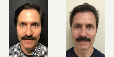 Case 8611 - Man treated with Hair Transplant