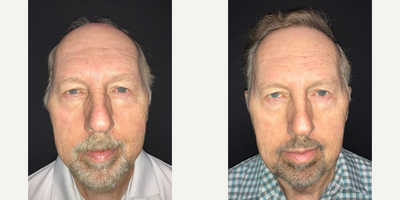 Case 8612 - Man treated with Hair Transplant