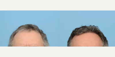 Case 8613 - 55-64 year old man treated with FUE Hair Transplant, Hair Transplant, Hair Loss Treatment, PRP for Hair Loss, NeoGraft