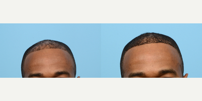 Case 8614 - 45-54 year old man treated with FUE Hair Transplant, Hair Transplant, Hair Loss Treatment, PRP for Hair Loss, NeoGraft