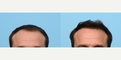 Case 8615 - 35-44 year old man treated with FUE Hair Transplant, Hair Transplant, Hair Loss Treatment, PRP for Hair Loss, NeoGraft