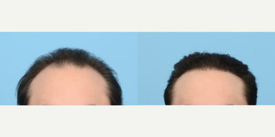 Case 8616 - 25-34 year old man treated with FUE Hair Transplant, Hair Transplant, Hair Loss Treatment, PRP for Hair Loss, NeoGraft