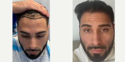 Case 8617 - 25-34 year old man treated with Hair Transplant