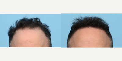 Case 8618 - 25-34 year old man treated with FUE Hair Transplant, Hair Transplant, Hair Loss Treatment, PRP for Hair Loss, NeoGraft