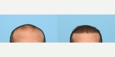 Case 8619 - 45-54 year old man treated with FUE Hair Transplant, Hair Transplant, PRP for Hair Loss, NeoGraft, Hair Loss Treatment