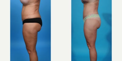 Case 862 - 35-44 year old woman treated with Tummy Tuck Revision, Mini Tummy Tuck, Drainless Tummy Tuck, Vaser Liposuction, Tummy Tuck, Dia