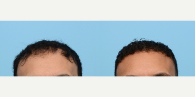 Case 8620 - 35-44 year old man treated with FUE Hair Transplant, Hair Transplant, Hair Loss Treatment, PRP for Hair Loss, Low-Level Laser Th