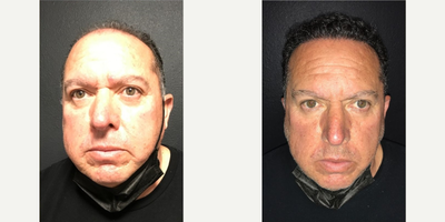 Case 8621 - Man treated with FUE Hair Transplant, Hair Transplant