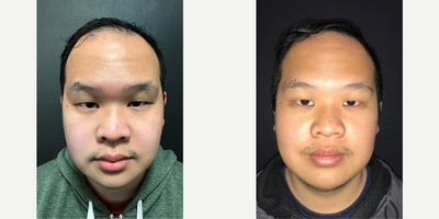 Case 8622 - Man treated with FUE Hair Transplant, Hair Transplant